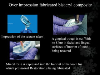 Over impression fabricated bisacryl composite
Impression of the sextant taken
A gingival trough is cut With
no 8 bur in facial and lingual
surfaces of imprint of tooth
being restored
Mixed resin is expressed into the Imprint of the tooth for
which provisonal Restoration s being fabricated
 