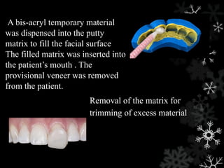 Removal of the matrix for
trimming of excess material
A bis-acryl temporary material
was dispensed into the putty
matrix to fill the facial surface
The filled matrix was inserted into
the patient’s mouth . The
provisional veneer was removed
from the patient.
 