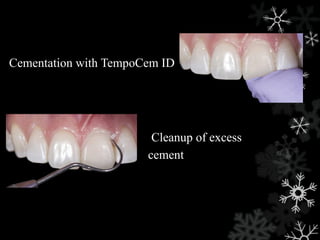 Cementation with TempoCem ID
Cleanup of excess
cement
 