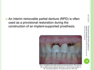  An interim removable partial denture (RPD) is often
used as a provisional restoration during the
construction of an implant-supported prosthesis.
04/12/2014
15
Provisionalrestorationoptionsin
implantdentistryAustralianDentalJournal
2007;52:(3):234-242
 