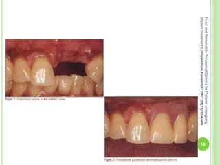 16
FixedandRemovableProvisionalOptionsforPatientsundergoing
ImplantTreatmentCompendiumNovember2007;28(11):604-609
 