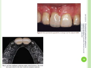 04/12/2014Provisionalrestorationoptionsin
implantdentistryAustralianDentalJournal
2007;52:(3):234-242
19
 