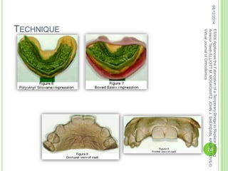 TECHNIQUE
04/12/2014
20
ESSIXAppliancestheFabricationofaTemporaryBridgetoReplaceMissing
AnteriorTeethELLIOTTM.MOSKOWITZ,JOHNJ.SHERIDAN,KRUNOTOVILO.
VirtualJournalofOrthodontics
 