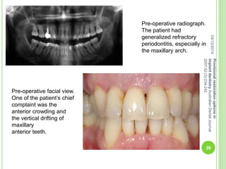 Pre-operative radiograph.
The patient had
generalized refractory
periodontitis, especially in
the maxillary arch.
Pre-operative facial view.
One of the patient’s chief
complaint was the
anterior crowding and
the vertical drifting of
maxillary
anterior teeth.
04/12/2014
26
Provisionalrestorationoptionsin
implantdentistryAustralianDentalJournal
2007;52:(3):234-242
 