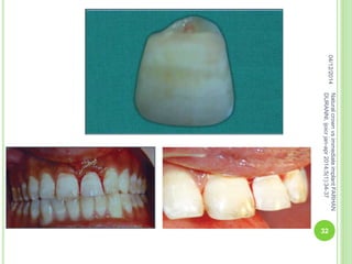 04/12/2014
32
NaturalcrownvsimmediateimplantFARHAN
DURANNI,ijoicrjan-apr2014;5(1):34-37
 