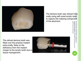 The denture tooth was relined intra-
orally using self cured acrylic resin
to capture the indexing component
of the abutment.
The relined denture tooth was
fitted over the practice implant
extra-orally. Note on the
deficiency from the implant
margin to the acrylic tooth due to
tissue impingement.
04/12/2014
45
Provisionalrestorationoptionsin
implantdentistryAustralianDentalJournal
2007;52:(3):234-242
 