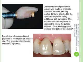 A screw retained provisional
crown was made at chairside
from the patient’s existing
partial denture, attached to the
temporary cylinder using
additional self cure resin. The
excess temporary cylinder is
reduced to follow the palatal
contour of the existing partial
denture and patient’s occlusion.
Facial view of screw retained
provisional restoration on tooth 11
site. The provisional restoration
was hand tightened.
04/12/2014
49
Provisionalrestorationoptionsin
implantdentistryAustralianDentalJournal
2007;52:(3):234-242
 