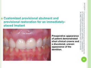 
Preoperative appearance
of patient demonstrated
short clinical crowns and
a discolored, uneven
appearance of the
dentition.
04/12/2014
51
Customizedprovisionalabutmentandprovisionalrestorationfor
animmediately-placedimplant,GERARDJ.LEMONGELLO,
JR,DMD,PractProcedAesthetDent2007;19(7):419-424.
 