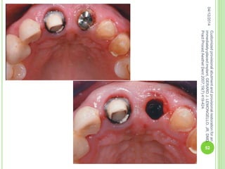 04/12/2014
52
Customizedprovisionalabutmentandprovisionalrestorationforan
immediately-placedimplant,GERARDJ.LEMONGELLO,JR,DMD,
PractProcedAesthetDent2007;19(7):419-424.
 