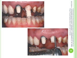 04/12/2014
54
Customizedprovisionalabutmentandprovisionalrestorationforan
immediately-placedimplant,GERARDJ.LEMONGELLO,JR,DMD,
PractProcedAesthetDent2007;19(7):419-424.
 