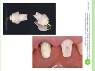 04/12/2014
55
Customizedprovisionalabutmentandprovisionalrestorationforan
immediately-placedimplant,GERARDJ.LEMONGELLO,JR,DMD,
PractProcedAesthetDent2007;19(7):419-424.
 