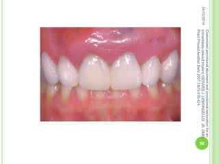 04/12/2014
56
Customizedprovisionalabutmentandprovisionalrestorationforan
immediately-placedimplant,GERARDJ.LEMONGELLO,JR,DMD,
PractProcedAesthetDent2007;19(7):419-424.
 