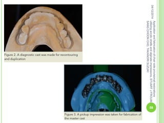 04/12/2014
58
Applicationandfabricationofchairsideprovisionalrestorations
utilizingacrylicshellsandalginateimpressions,STUARTJFROUM,
SANGCHOONCHO,TAKANORISUZUKI
 