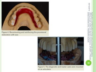 04/12/2014
59
Applicationandfabricationofchairsideprovisionalrestorations
utilizingacrylicshellsandalginateimpressions,STUARTJFROUM,
SANGCHOONCHO,TAKANORISUZUKI
 