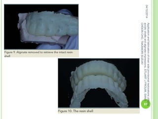 04/12/2014
61
Applicationandfabricationofchairsideprovisionalrestorationsutilizing
acrylicshellsandalginateimpressions,STUARTJFROUM,SANG
CHOONCHO,TAKANORISUZUKI
 