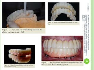 04/12/2014
63
Applicationandfabricationofchairsideprovisional
restorationsutilizingacrylicshellsandalginateimpressions,
STUARTJFROUM,SANGCHOONCHO,TAKANORI
SUZUKI
 
