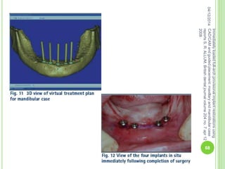 04/12/2014
Immediatelyloadedfull-archprovisionalimplantrestorationsusing
CAD/CAMandguidedplacement:maxillaryandmandibularcase
reportsS.R.ALLUM,Britishdentaljournalvolume204no.7apr12
2008
68
 