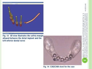 04/12/2014
Immediatelyloadedfull-archprovisionalimplantrestorationsusing
CAD/CAMandguidedplacement:maxillaryandmandibularcasereports
S.R.ALLUM,Britishdentaljournalvolume204no.7apr122008
69
 