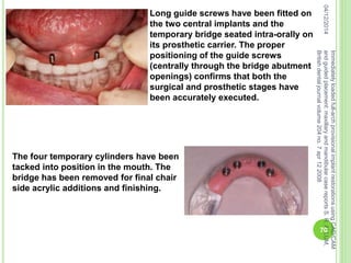 04/12/2014
Immediatelyloadedfull-archprovisionalimplantrestorationsusingCAD/CAM
andguidedplacement:maxillaryandmandibularcasereportsS.R.ALLUM,
Britishdentaljournalvolume204no.7apr122008
70
Long guide screws have been fitted on
the two central implants and the
temporary bridge seated intra-orally on
its prosthetic carrier. The proper
positioning of the guide screws
(centrally through the bridge abutment
openings) confirms that both the
surgical and prosthetic stages have
been accurately executed.
The four temporary cylinders have been
tacked into position in the mouth. The
bridge has been removed for final chair
side acrylic additions and finishing.
 