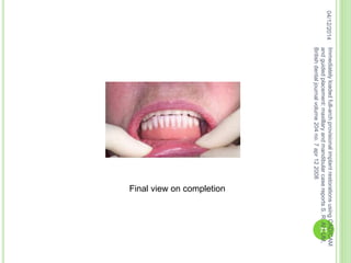 04/12/2014Immediatelyloadedfull-archprovisionalimplantrestorationsusingCAD/CAM
andguidedplacement:maxillaryandmandibularcasereportsS.R.ALLUM,
Britishdentaljournalvolume204no.7apr122008
71
Final view on completion
 