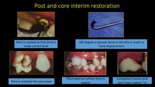 Post and core interim restoration
Wire is marked so that bend is
made correct level
180 degree or greater bend in the wire is made to
resist displacement
Wire is inserted into post place
Filled external surface form is
seated
Completed interim post
and crown restoration
30
 