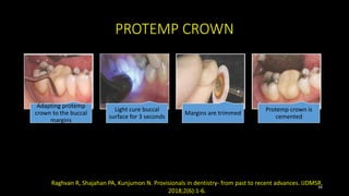 PROTEMP CROWN
Adapting protemp
crown to the buccal
margins
Light cure buccal
surface for 3 seconds
Margins are trimmed
Protemp crown is
cemented
34
Raghvan R, Shajahan PA, Kunjumon N. Provisionals in dentistry- from past to recent advances. IJDMSR.
2018;2(6):1-6.
 