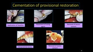 Removal of excess
cement
Removal of excess
cement
Removing
interproximal excess
cement
Application of Vaseline Placement of luting
agent
Cementation of provisional restoration
39
 