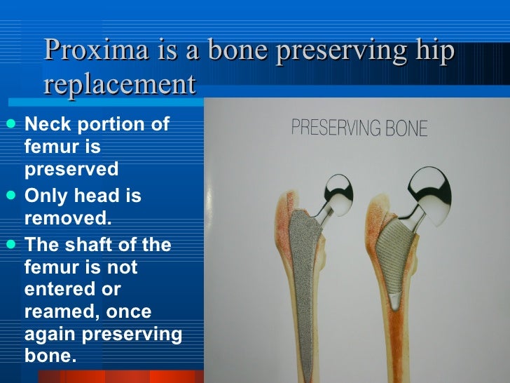 Short Stem Hip Replacement Proxima hip replacement