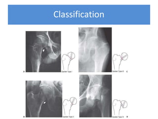 proximalfemoralfractures-180330205050.pptx