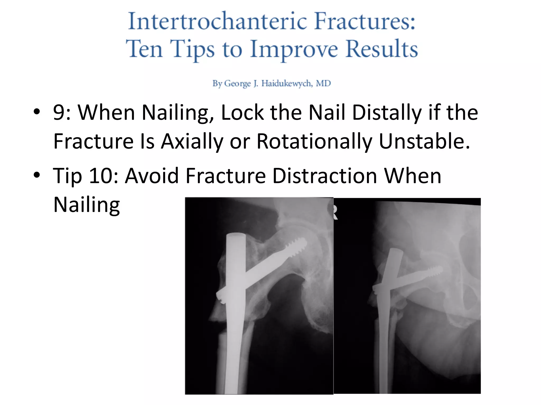 • 9: When Nailing, Lock the Nail Distally if the
Fracture Is Axially or Rotationally Unstable.
• Tip 10: Avoid Fracture Distraction When
Nailing
 