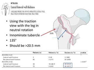 Traction Internal Rotation View Proximal femoral fractures | PDF
