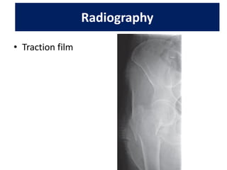 Traction Internal Rotation View Proximal femoral fractures | PDF