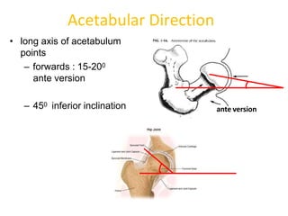 Proximal femoral osteotomies.pptx