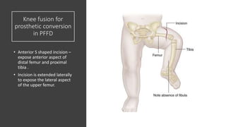 Proximal femur focal def | PPTX