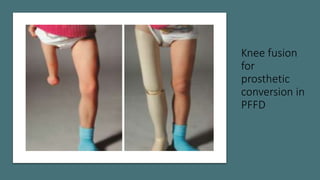 Proximal femur focal def | PPTX