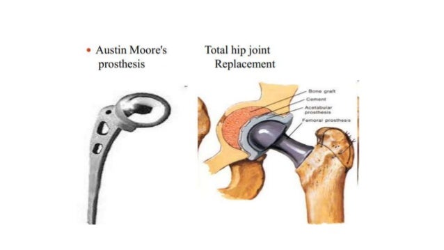 Proximal femur fractures