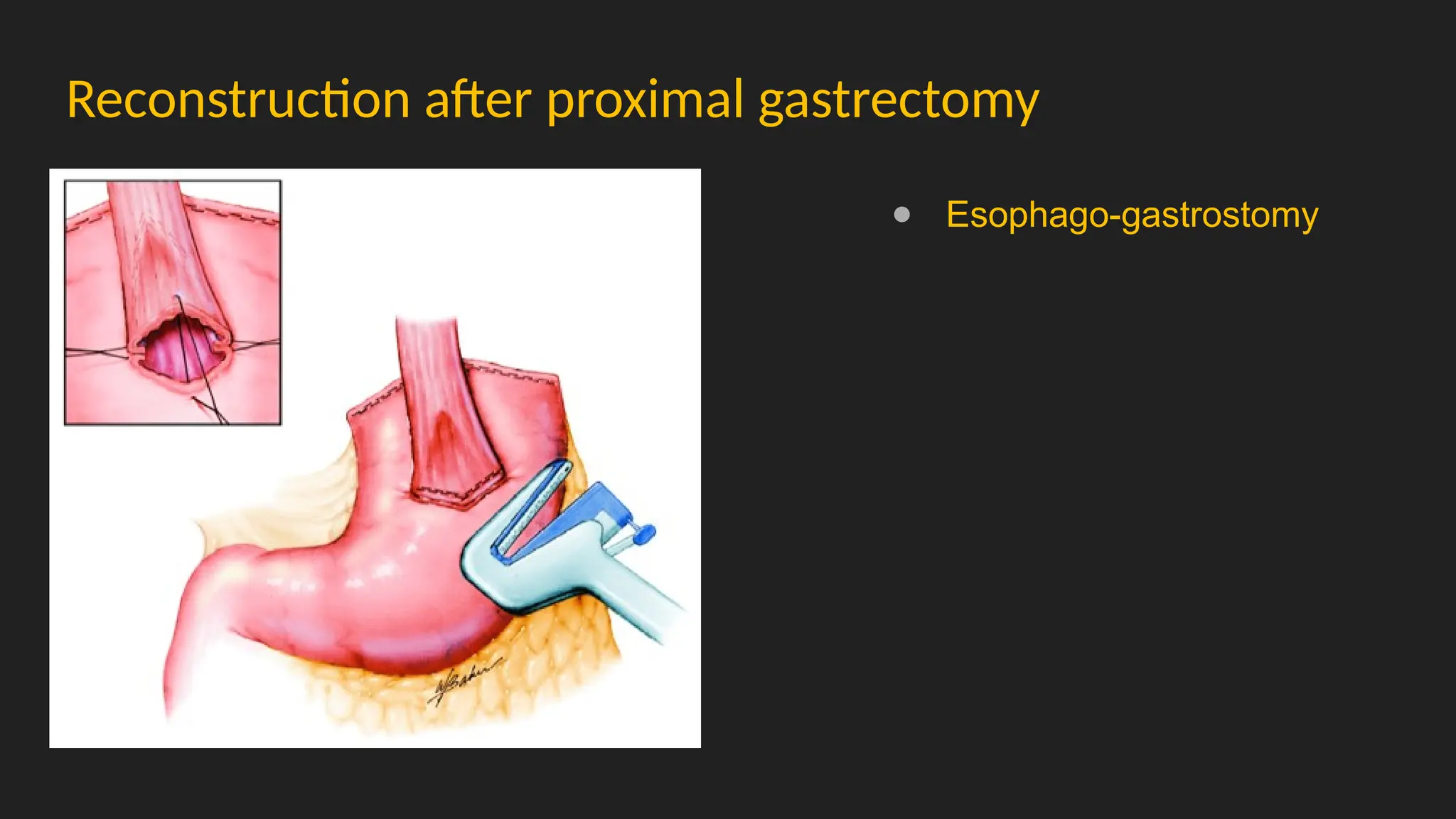 Reconstruction after proximal gastrectomy
● Esophago-gastrostomy
 
