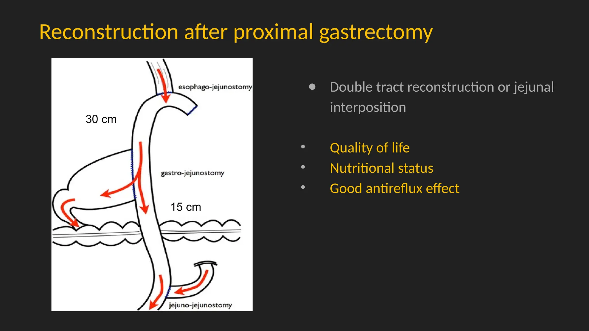 Reconstruction after proximal gastrectomy
● Double tract reconstruction or jejunal
interposition
• Quality of life
• Nutritional status
• Good antireflux effect
30 cm
15 cm
 