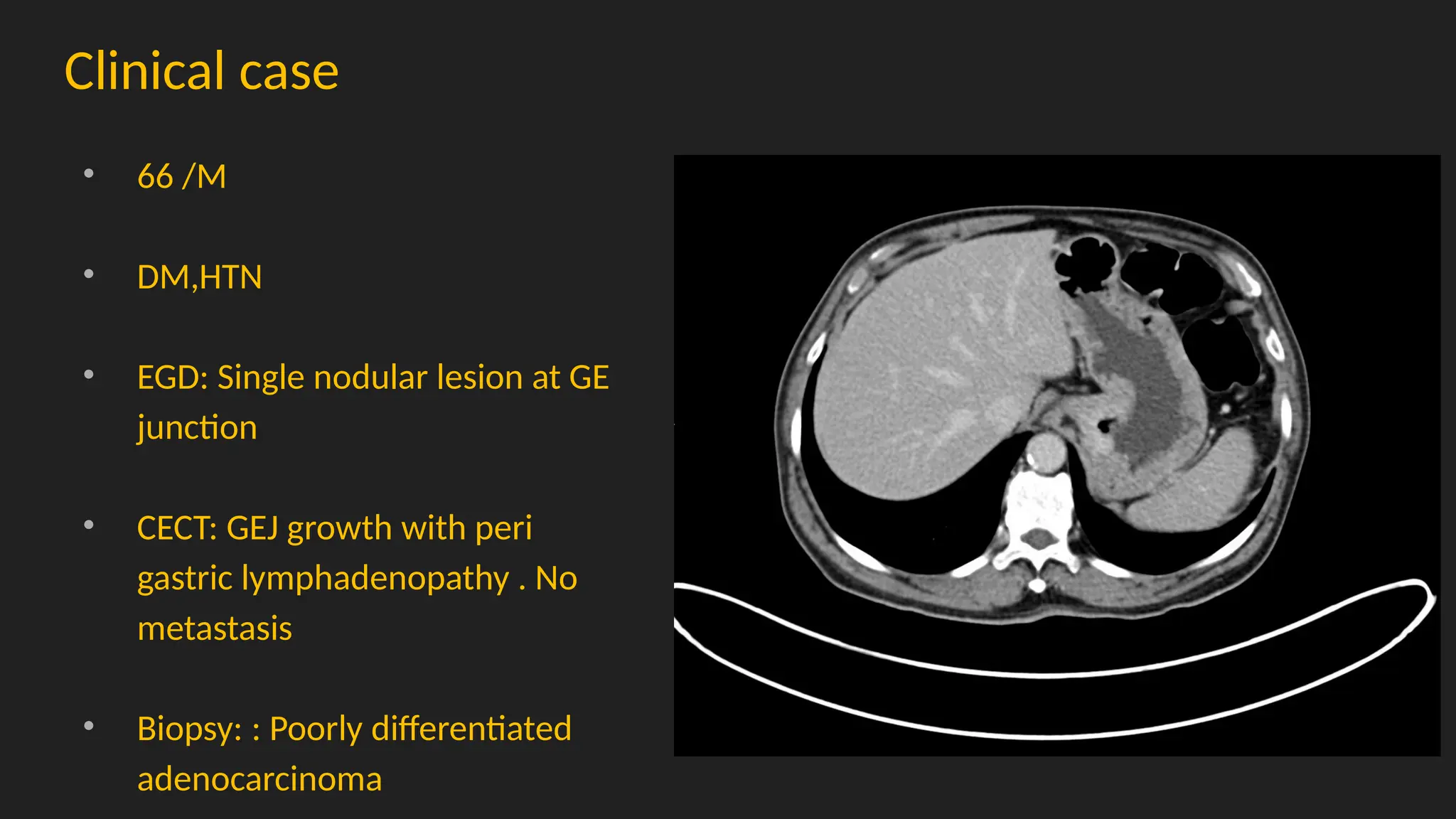 Clinical case
• 66 /M
• DM,HTN
• EGD: Single nodular lesion at GE
junction
• CECT: GEJ growth with peri
gastric lymphadenopathy . No
metastasis
• Biopsy: : Poorly differentiated
adenocarcinoma
 