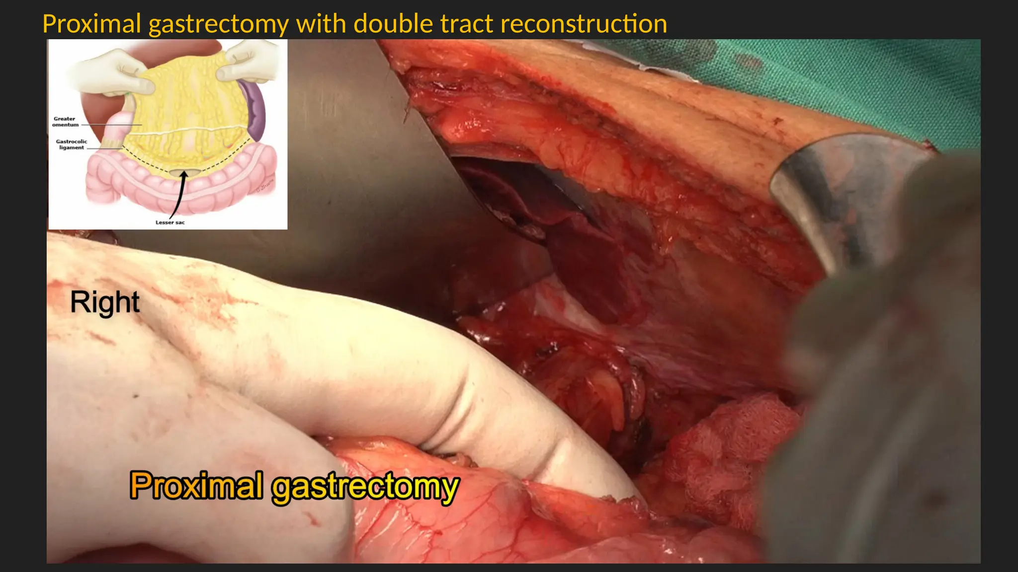 Proximal gastrectomy with double tract reconstruction
 