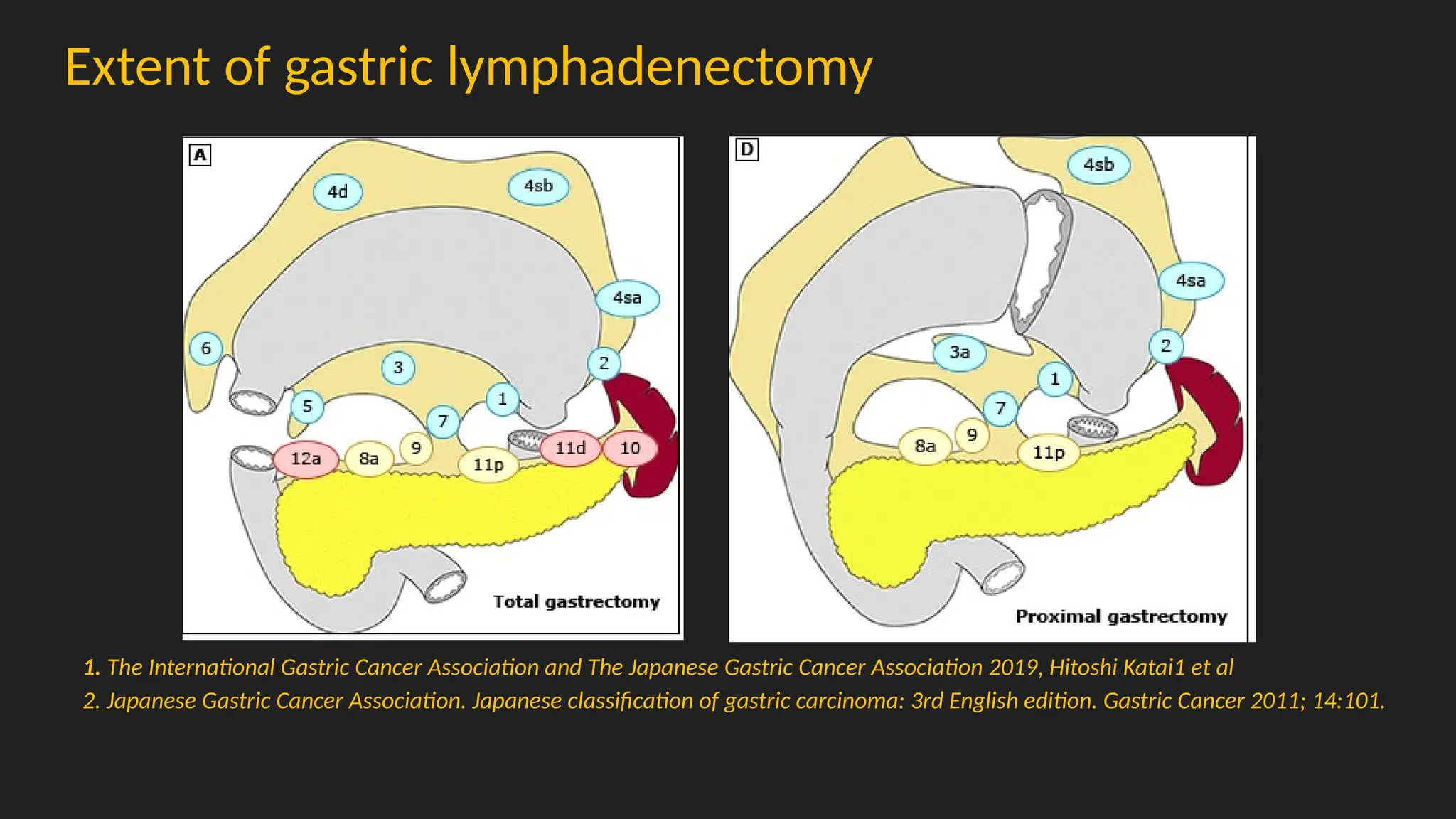 Extent of gastric lymphadenectomy
1. The International Gastric Cancer Association and The Japanese Gastric Cancer Association 2019, Hitoshi Katai1 et al
2. Japanese Gastric Cancer Association. Japanese classification of gastric carcinoma: 3rd English edition. Gastric Cancer 2011; 14:101.
 