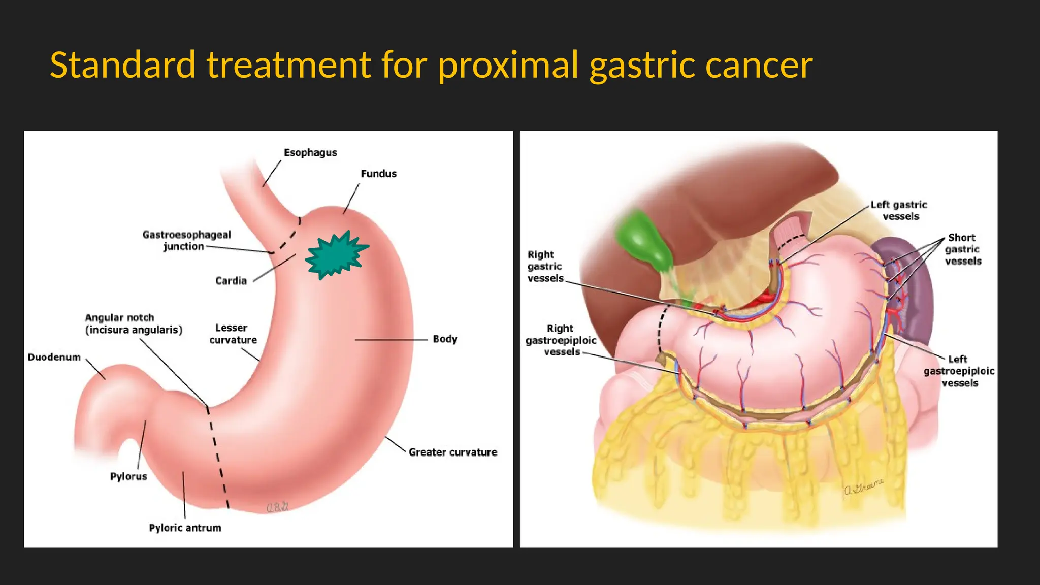 Standard treatment for proximal gastric cancer
 
