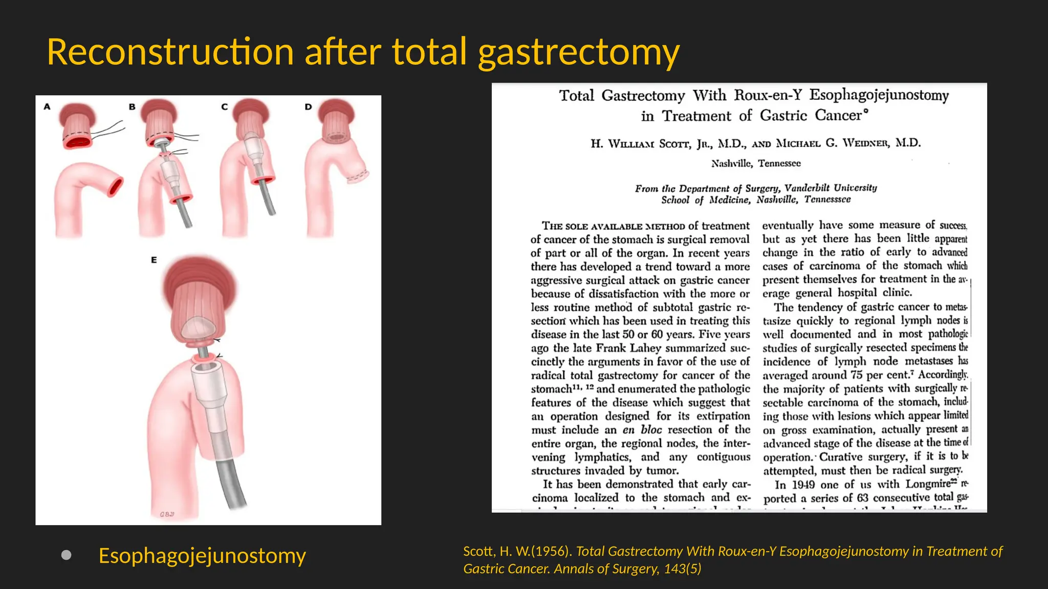 Reconstruction after total gastrectomy
● Esophagojejunostomy Scott, H. W.(1956). Total Gastrectomy With Roux-en-Y Esophagojejunostomy in Treatment of
Gastric Cancer. Annals of Surgery, 143(5)
 