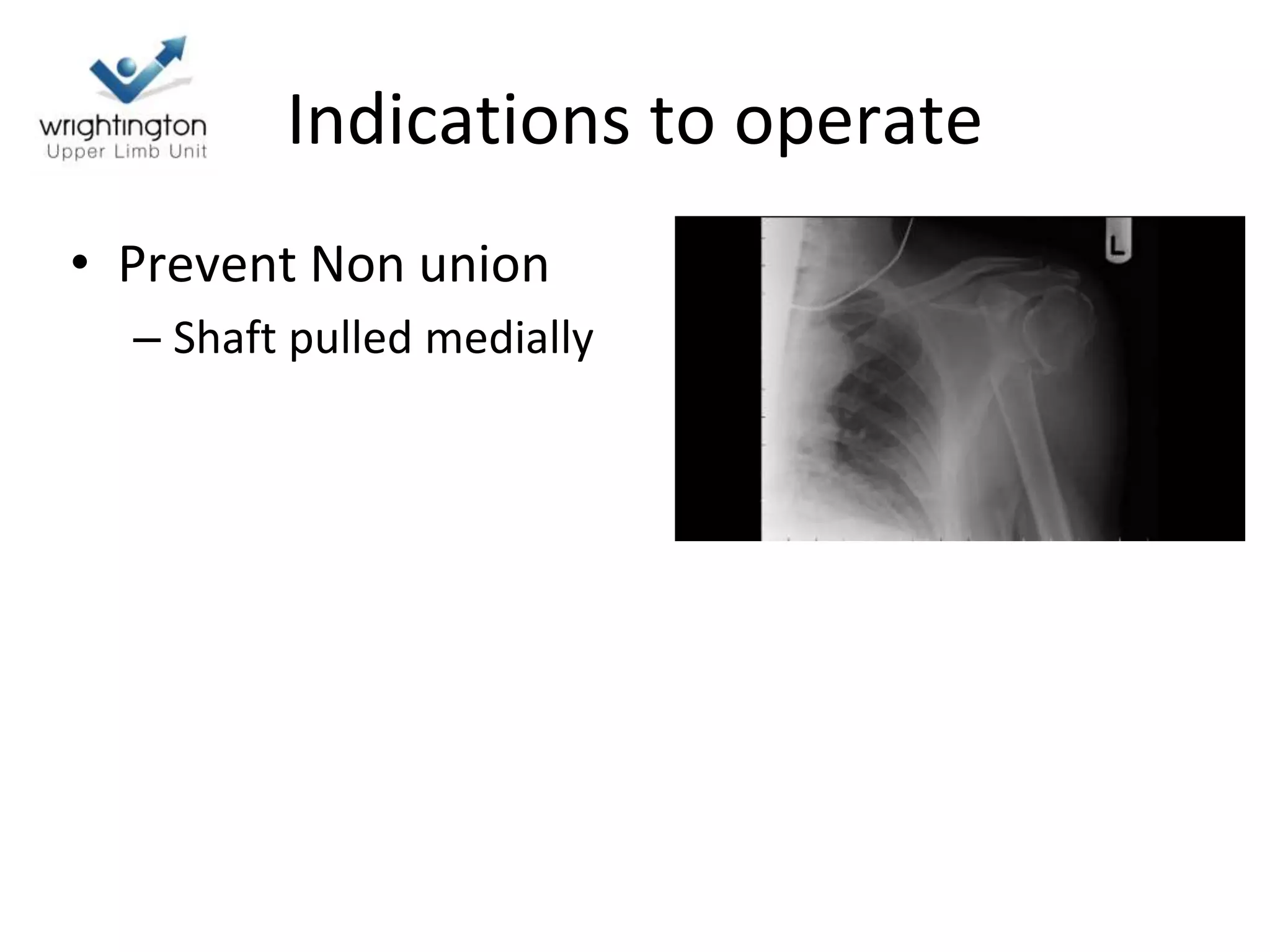 Indications to operate
• Prevent Non union
– Shaft pulled medially
 