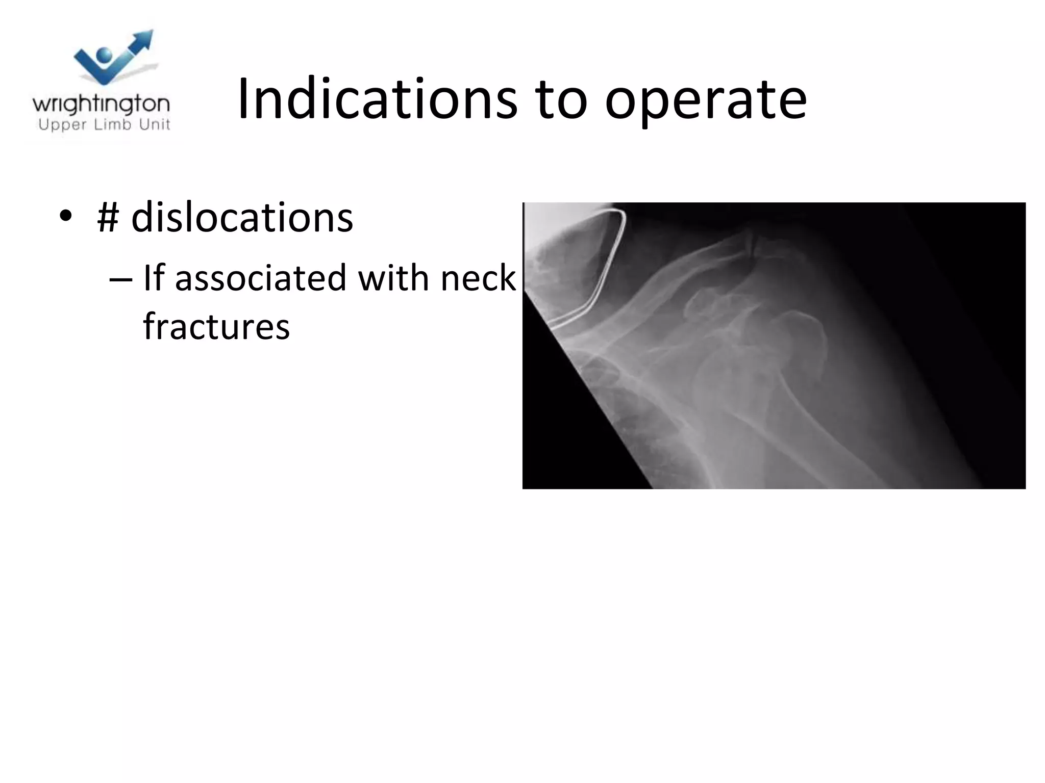 Indications to operate
• # dislocations
– If associated with neck
fractures
 