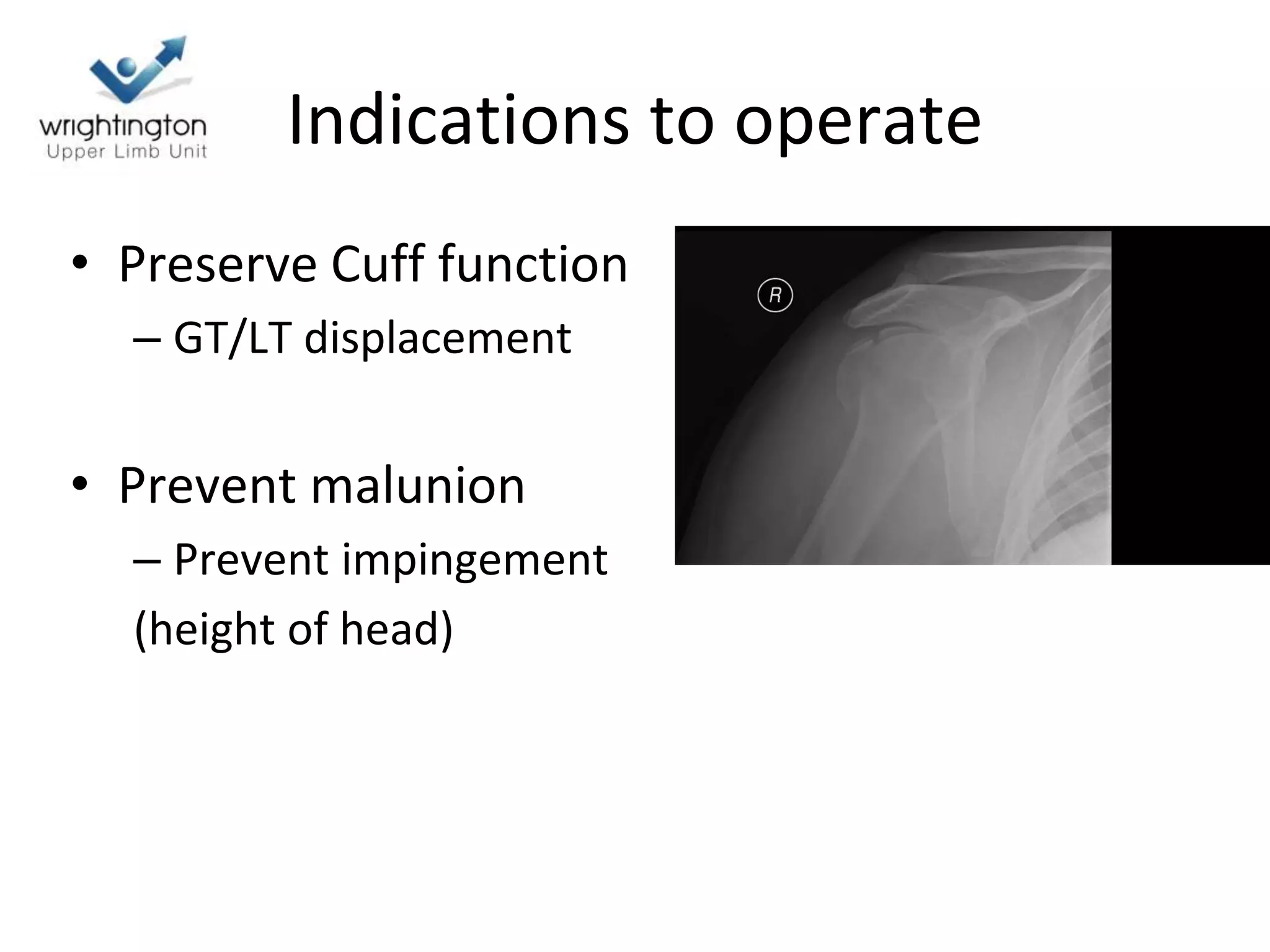 Indications to operate
• Preserve Cuff function
– GT/LT displacement
• Prevent malunion
– Prevent impingement
(height of head)
 
