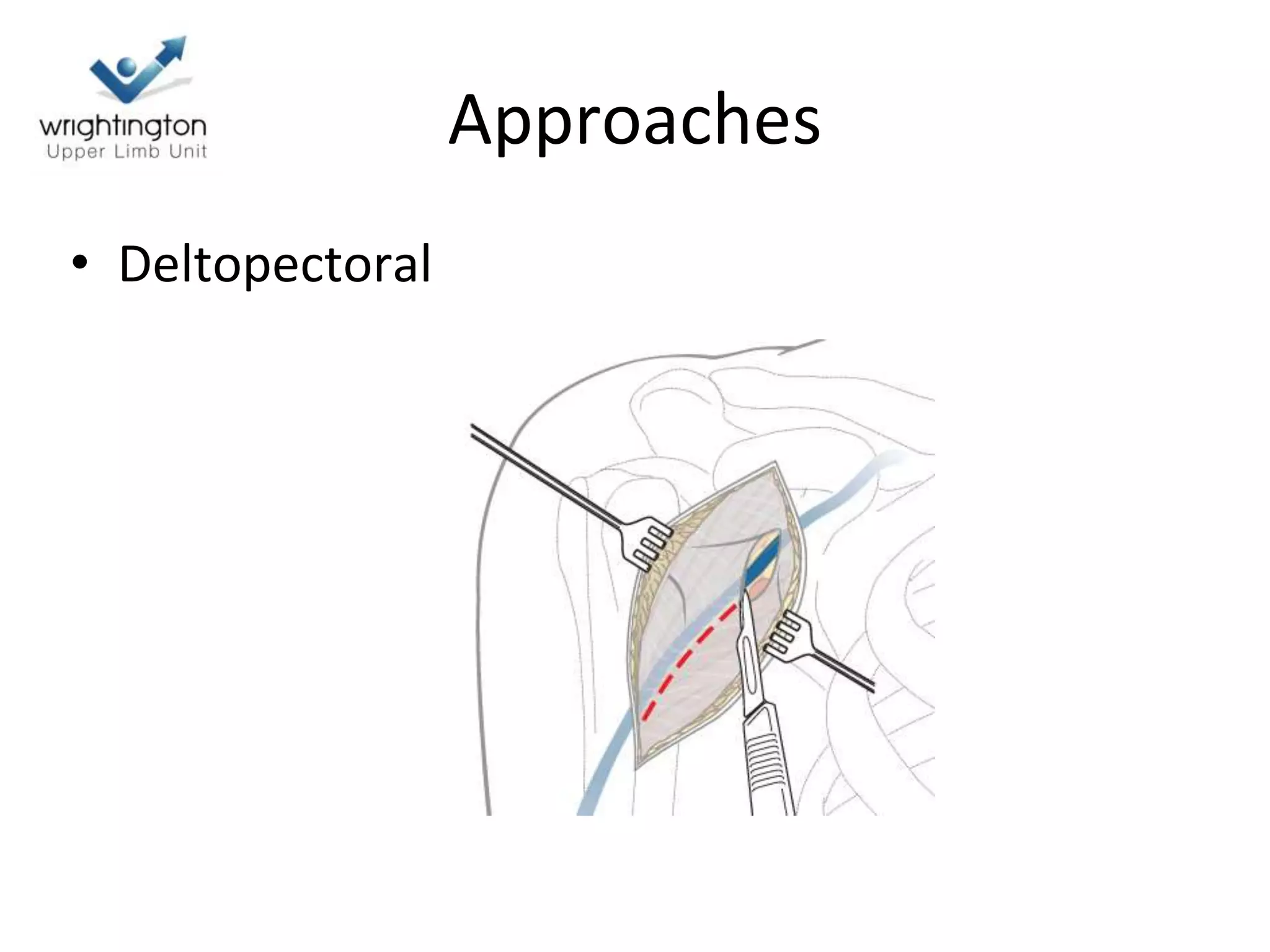 Approaches
• Deltopectoral
 