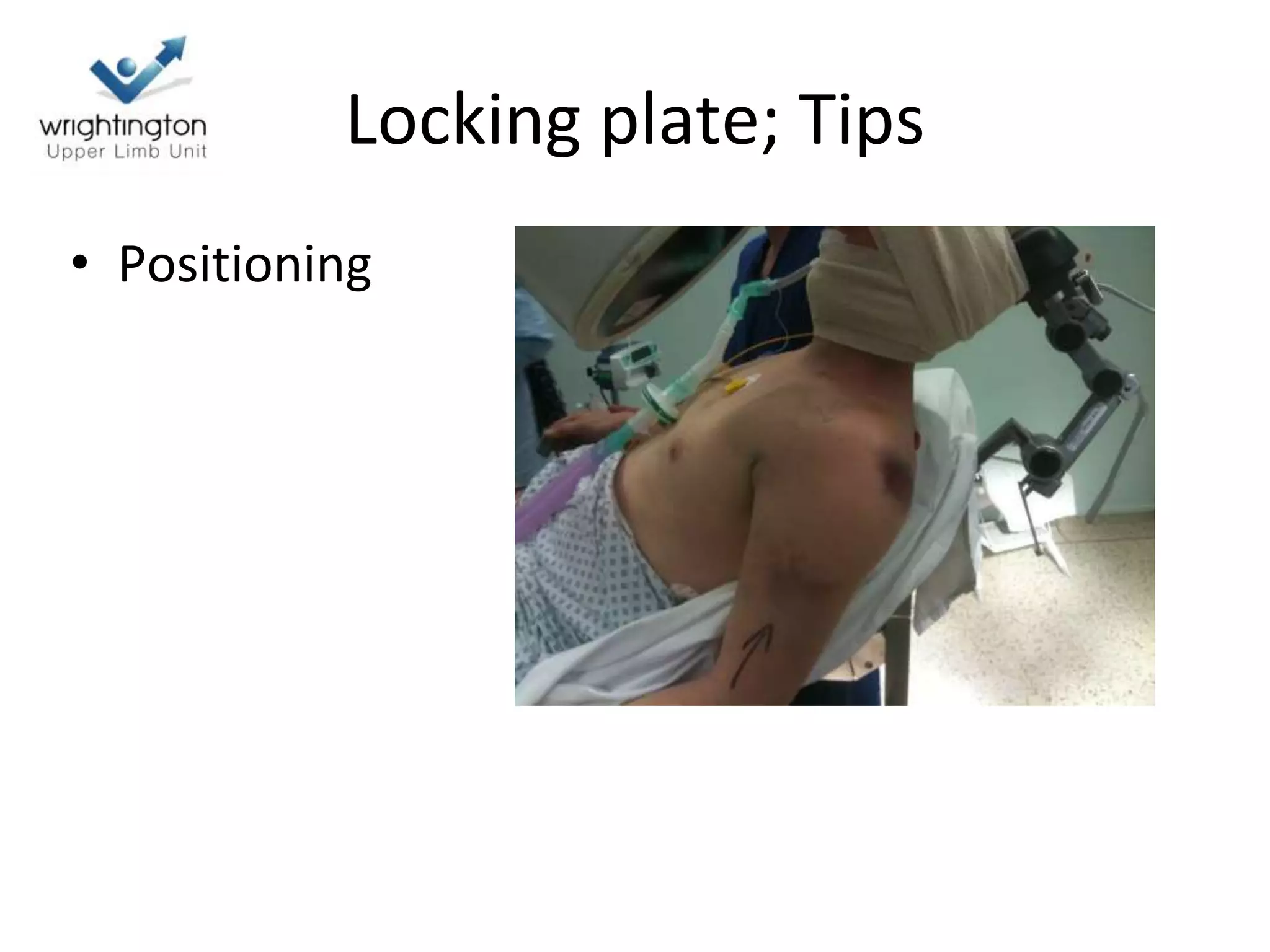 Locking plate; Tips
• Positioning
 