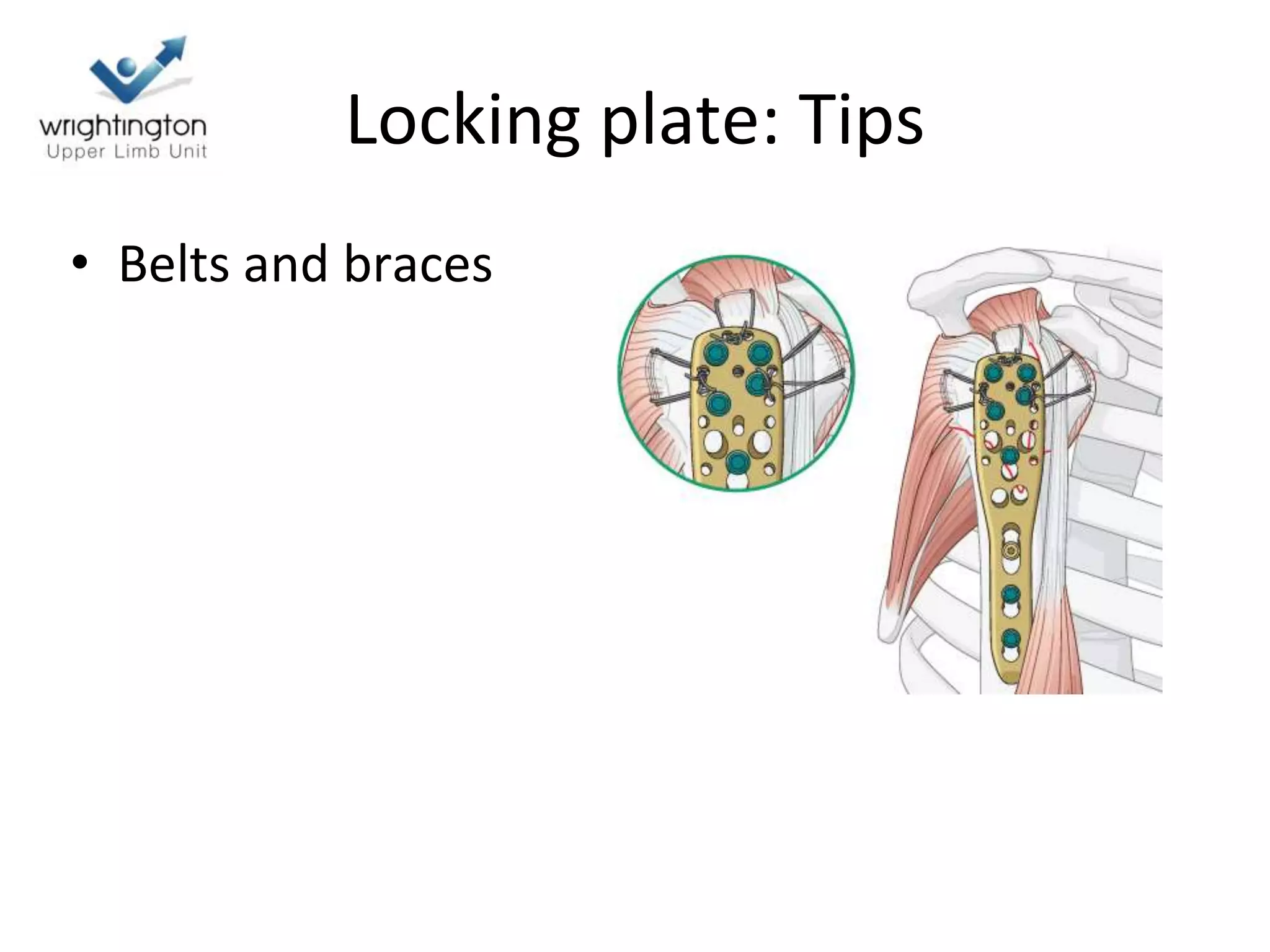 Locking plate: Tips
• Belts and braces
 