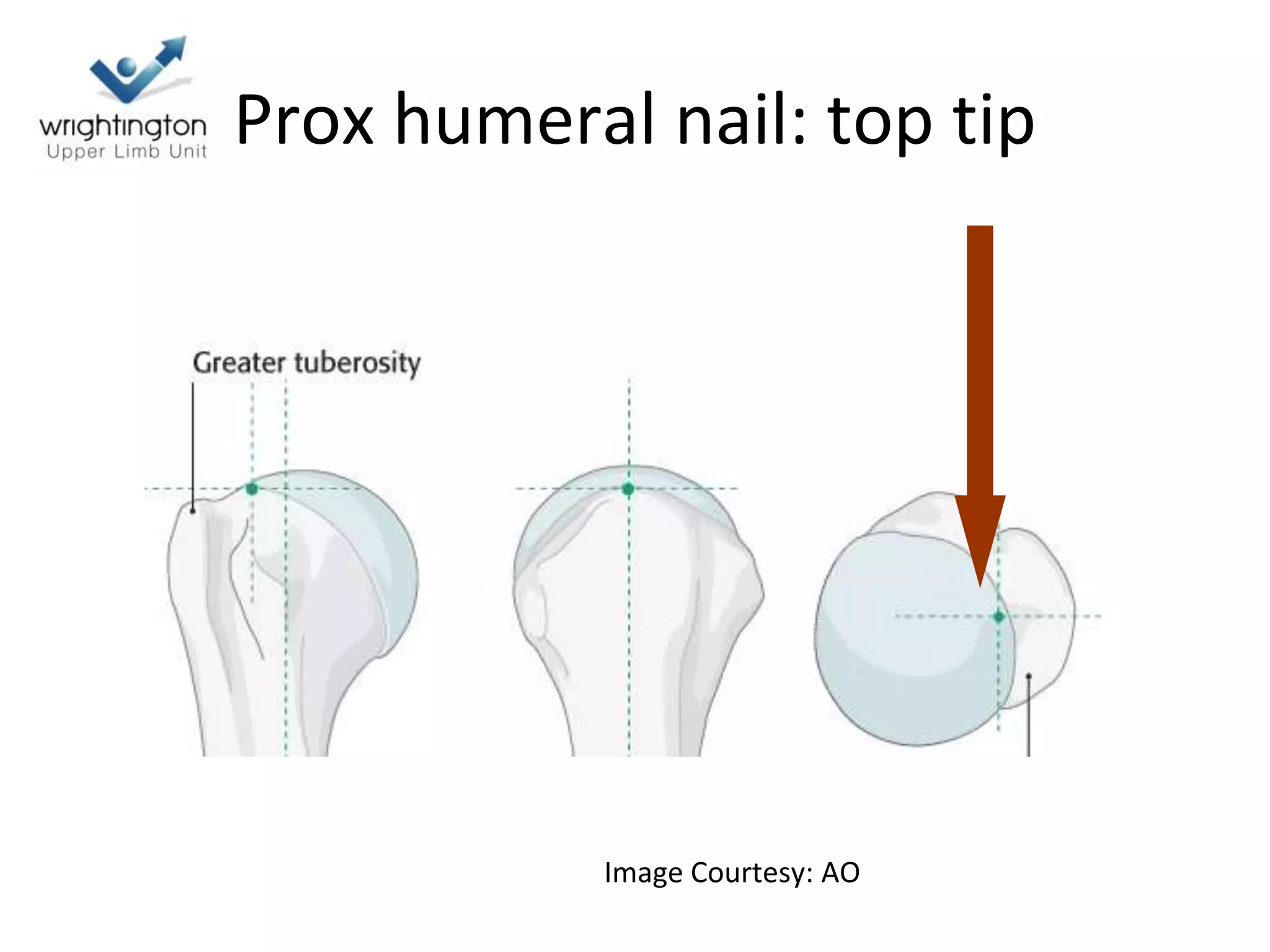 Prox humeral nail: top tip
Image Courtesy: AO
 